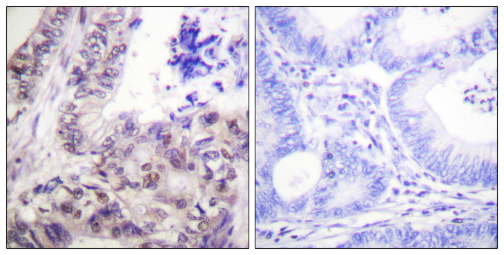 CASP9 / Caspase 9 Antibody - Immunohistochemistry analysis of paraffin-embedded human colon carcinoma, using Caspase 9 (Phospho-Ser144) Antibody. The picture on the right is blocked with the phospho peptide.