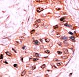 CASP9 / Caspase 9 Antibody - Formalin-fixed and paraffin-embedded human cancer tissue reacted with the primary antibody, which was peroxidase-conjugated to the secondary antibody, followed by AEC staining. This data demonstrates the use of this antibody for immunohistochemistry; clinical relevance has not been evaluated. BC = breast carcinoma; HC = hepatocarcinoma.