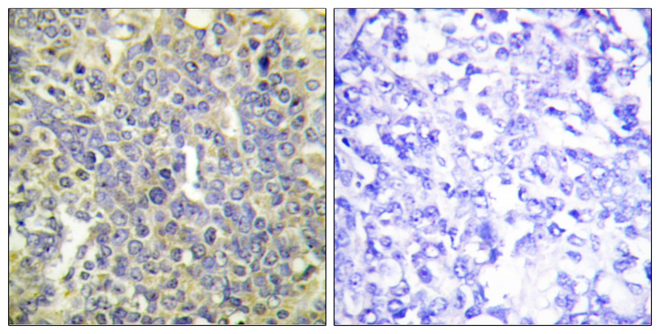 CASP9 / Caspase 9 Antibody - Immunohistochemistry analysis of paraffin-embedded human lung carcinoma, using Caspase 9 (Phospho-Thr125) Antibody. The picture on the right is blocked with the phospho peptide.
