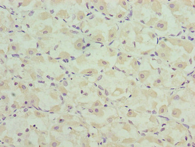 CASQ1 / Calsequestrin 1 Antibody - Immunohistochemistry of paraffin-embedded human gastric cancer using CASQ1 Antibody at dilution of 1:100