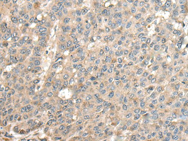 CASQ1 / Calsequestrin 1 Antibody - Immunohistochemistry of paraffin-embedded Human liver cancer tissue  using CASQ1 Polyclonal Antibody at dilution of 1:100(×200)