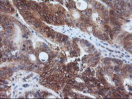 CAST / Calpastatin Antibody - IHC of paraffin-embedded Carcinoma of Human pancreas tissue using anti-CAST mouse monoclonal antibody. (Heat-induced epitope retrieval by 10mM citric buffer, pH6.0, 100C for 10min).