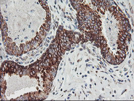 CAST / Calpastatin Antibody - IHC of paraffin-embedded Carcinoma of Human prostate tissue using anti-CAST mouse monoclonal antibody. (Heat-induced epitope retrieval by 10mM citric buffer, pH6.0, 100C for 10min).