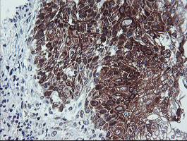 CAST / Calpastatin Antibody - IHC of paraffin-embedded Carcinoma of Human bladder tissue using anti-CAST mouse monoclonal antibody. (Heat-induced epitope retrieval by 10mM citric buffer, pH6.0, 100C for 10min).