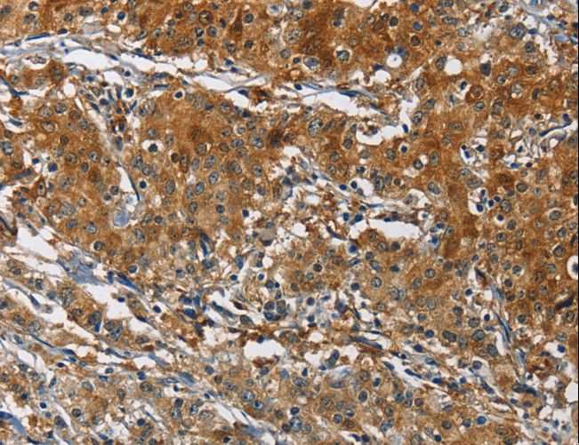 CAST / Calpastatin Antibody - Immunohistochemistry of paraffin-embedded Human gastric cancer using CAST Polyclonal Antibody at dilution of 1:70.