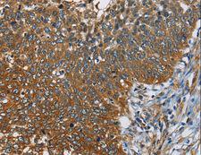 CAST / Calpastatin Antibody - Immunohistochemistry of paraffin-embedded Human cervical cancer using CAST Polyclonal Antibody at dilution of 1:60.