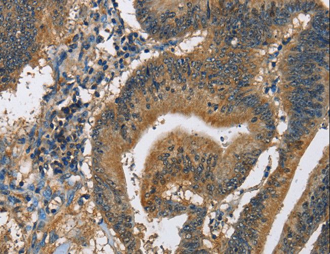 CAST / Calpastatin Antibody - Immunohistochemistry of paraffin-embedded Human colon cancer using CAST Polyclonal Antibody at dilution of 1:60.