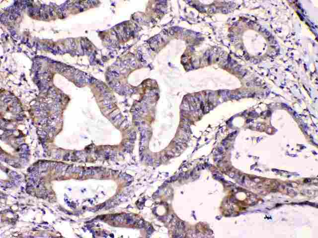 CAST / Calpastatin Antibody - Calpastatin was detected in paraffin-embedded sections of human intetsinal cancer tissues using rabbit anti- Calpastatin Antigen Affinity purified polyclonal antibody