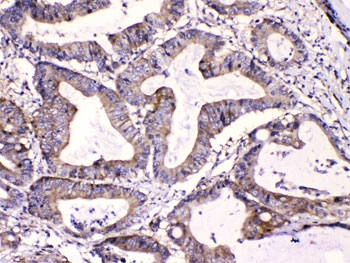 CAST / Calpastatin Antibody - IHC testing of FFPE human intestinal cancer tissue with Calpastatin antibody at 1ug/ml. HIER: steam section in pH6 citrate buffer for 20 min.