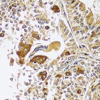 CAST / Calpastatin Antibody - Immunohistochemistry of paraffin-embedded Human uterine cancer using CAST Polyclonal Antibody at dilution of 1:100 (40x lens).