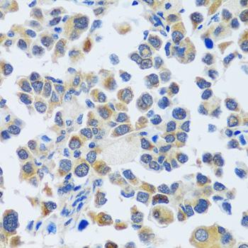 CAST / Calpastatin Antibody - Immunohistochemistry of paraffin-embedded Human lung cancer using CAST Polyclonal Antibody at dilution of 1:100 (40x lens).