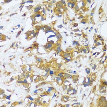 CAST / Calpastatin Antibody - Immunohistochemistry of paraffin-embedded Human breast cancer using CAST Polyclonal Antibody at dilution of 1:100 (40x lens).