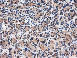 CAT / Catalase Antibody - IHC of paraffin-embedded Carcinoma of Human thyroid tissue using anti-CAT mouse monoclonal antibody. (Heat-induced epitope retrieval by 10mM citric buffer, pH6.0, 100C for 10min).
