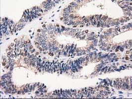 CAT / Catalase Antibody - IHC of paraffin-embedded Adenocarcinoma of Human endometrium tissue using anti-CAT mouse monoclonal antibody. (Heat-induced epitope retrieval by 10mM citric buffer, pH6.0, 100C for 10min).