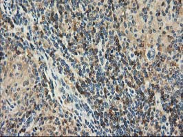 CAT / Catalase Antibody - IHC of paraffin-embedded Human lymphoma tissue using anti-CAT mouse monoclonal antibody. (Heat-induced epitope retrieval by 10mM citric buffer, pH6.0, 100C for 10min).