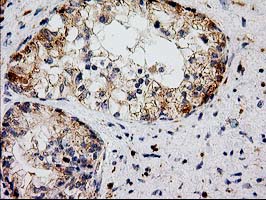 CAT / Catalase Antibody - IHC of paraffin-embedded Adenocarcinoma of Human ovary tissue using anti-CAT mouse monoclonal antibody.