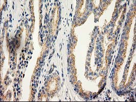 CAT / Catalase Antibody - IHC of paraffin-embedded Carcinoma of Human prostate tissue using anti-CAT mouse monoclonal antibody.