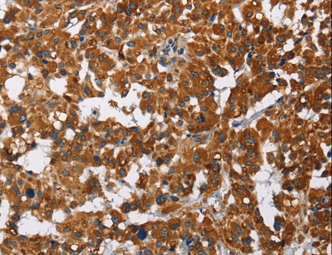 CAT / Catalase Antibody - Immunohistochemistry of paraffin-embedded Human thyroid cancer using CAT Polyclonal Antibody at dilution of 1:40.