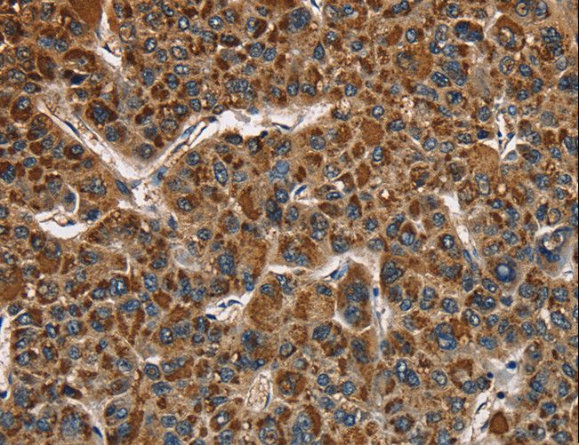 CAT / Catalase Antibody - Immunohistochemistry of paraffin-embedded Human liver cancer using CAT Polyclonal Antibody at dilution of 1:40.