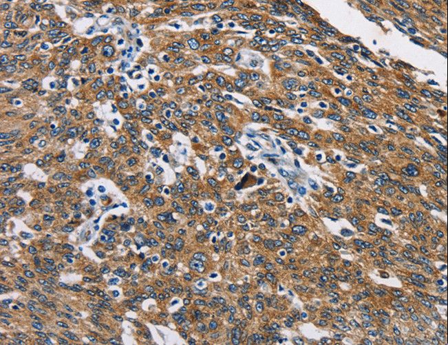 CAT / Catalase Antibody - Immunohistochemistry of paraffin-embedded Human ovarian cancer using CAT Polyclonal Antibody at dilution of 1:40.