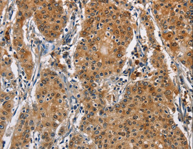 CAT / Catalase Antibody - Immunohistochemistry of paraffin-embedded Human gastric cancer using CAT Polyclonal Antibody at dilution of 1:40.