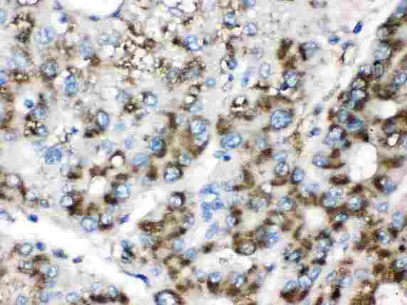 CAT / Catalase Antibody - Catalase was detected in paraffin-embedded sections of human liver cancer tissues using rabbit anti- Catalase Antigen Affinity purified polyclonal antibody