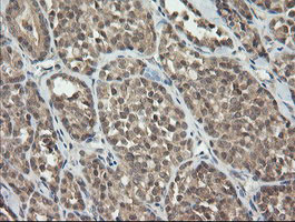 CATIP / C2orf62 Antibody - IHC of paraffin-embedded Carcinoma of Human thyroid tissue using anti-C2orf62 mouse monoclonal antibody.