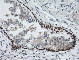 CATIP / C2orf62 Antibody - IHC of paraffin-embedded Carcinoma of Human prostate tissue using anti-C2orf62 mouse monoclonal antibody.