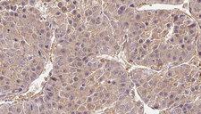 CATSPER4 Antibody - 1:100 staining human liver carcinoma tissues by IHC-P. The sample was formaldehyde fixed and a heat mediated antigen retrieval step in citrate buffer was performed. The sample was then blocked and incubated with the antibody for 1.5 hours at 22°C. An HRP conjugated goat anti-rabbit antibody was used as the secondary.