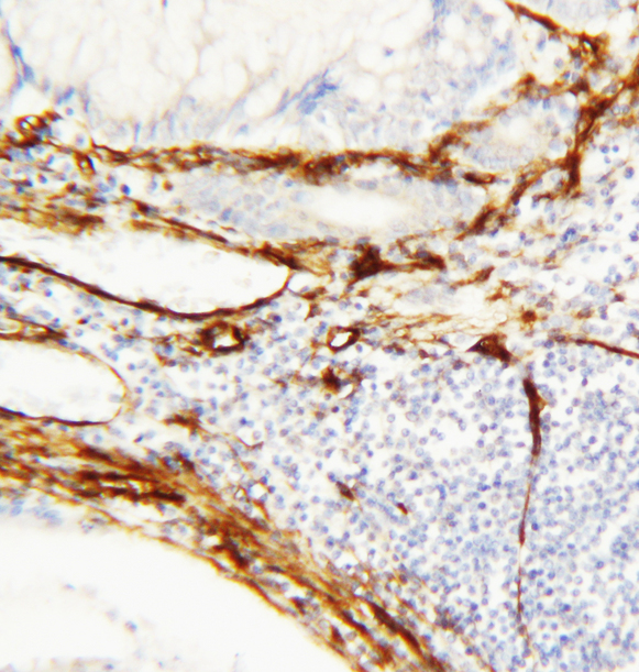 CAV1 / Caveolin 1 Antibody - CAV1 / Caveolin 1 antibody. IHC(P): Human Breast Cancer Tissue.