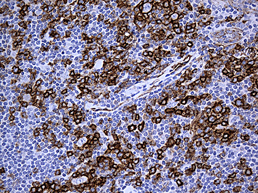 CAV1 / Caveolin 1 Antibody - Immunohistochemical staining of paraffin-embedded Human lymphoma tissue using anti-CAV1 mouse monoclonal antibody. (Heat-induced epitope retrieval by 1mM EDTA in 10mM Tris buffer. (pH8.5) at 120°C for 3 min. (1:500)