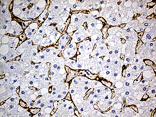 CAV1 / Caveolin 1 Antibody - Immunohistochemical staining of paraffin-embedded Carcinoma of Human liver tissue using anti-CAV1 mouse monoclonal antibody. (Heat-induced epitope retrieval by 1mM EDTA in 10mM Tris buffer. (pH8.5) at 120°C for 3 min. (1:500)