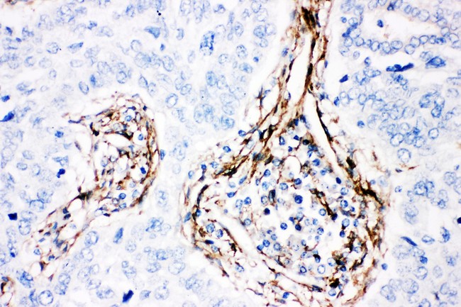CAV1 / Caveolin 1 Antibody - Caveolin-1 antibody IHC-paraffin: Human Lung Cancer Tissue.