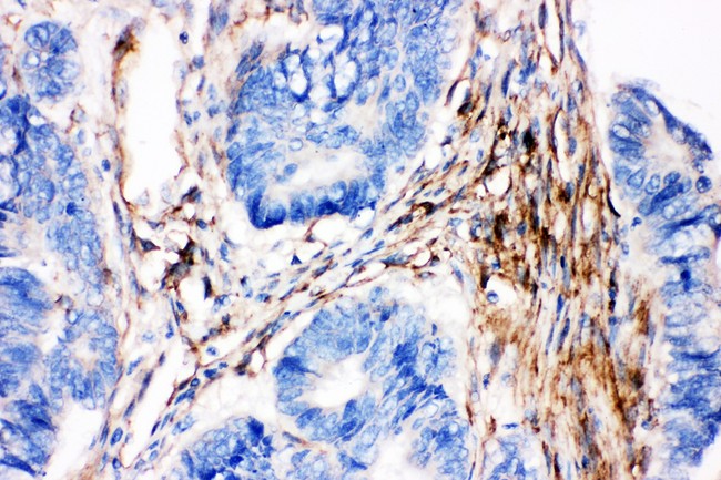 CAV2 / Caveolin 2 Antibody - Caveolin-2 antibody IHC-paraffin: Human Intestinal Cancer Tissue.