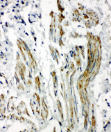 CAV2 / Caveolin 2 Antibody - CAV2 / Caveolin 2 antibody. IHC(P): Human Lung Cancer Tissue.