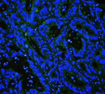CAV3 / Caveolin 3 Antibody - IHC staining of FFPE human intestinal cancer with Caveolin-3 antibody at 1ug/ml (green) and DAPI nuclear stain (blue). HIER: boil tissue sections in pH6, 10mM citrate buffer, for 10-20 min and allow to cool before testing.