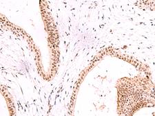 CBFA2T2 / MTGR1 Antibody - Immunohistochemistry of paraffin-embedded Human breast cancer tissue  using CBFA2T2 Polyclonal Antibody at dilution of 1:60(×200)