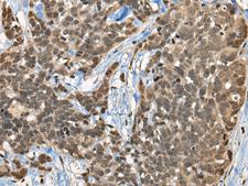 CBFA2T3 Antibody - Immunohistochemistry of paraffin-embedded Human thyroid cancer tissue  using CBFA2T3 Polyclonal Antibody at dilution of 1:45(×200)