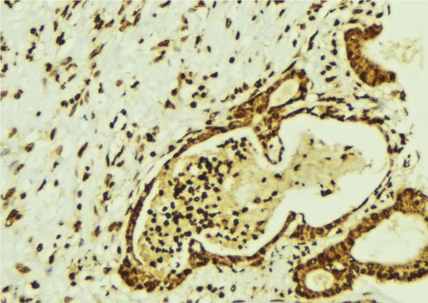 CBFB Antibody - 1:100 staining human breast carcinoma tissue by IHC-P. The sample was formaldehyde fixed and a heat mediated antigen retrieval step in citrate buffer was performed. The sample was then blocked and incubated with the antibody for 1.5 hours at 22°C. An HRP conjugated goat anti-rabbit antibody was used as the secondary.