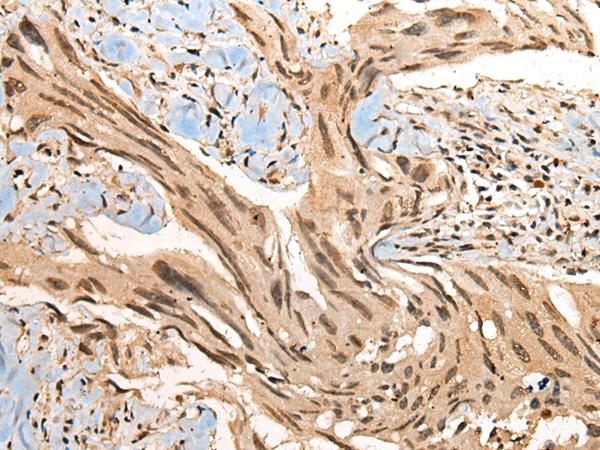 CBFB Antibody - Immunohistochemistry of paraffin-embedded Human breast cancer tissue  using CBFB Polyclonal Antibody at dilution of 1:40(×200)