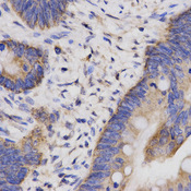 CBLB Antibody - Immunohistochemistry of paraffin-embedded human rectal cancer using CBLB antibody at dilution of 1:200 (x400 lens)
