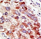 CBLC Antibody - Formalin-fixed and paraffin-embedded human cancer tissue reacted with the primary antibody, which was peroxidase-conjugated to the secondary antibody, followed by AEC staining. This data demonstrates the use of this antibody for immunohistochemistry; clinical relevance has not been evaluated. BC = breast carcinoma; HC = hepatocarcinoma.