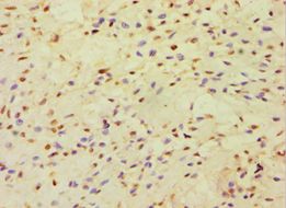 CBLC Antibody - Immunohistochemistry of paraffin-embedded human breast cancer using antibody at 1:100 dilution.