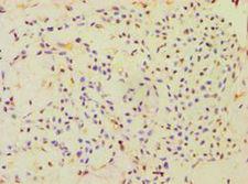 CBLC Antibody - Immunohistochemistry of paraffin-embedded human breast cancer using antibody at 1:100 dilution.