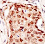 CBLC Antibody - Formalin-fixed and paraffin-embedded human cancer tissue reacted with the primary antibody, which was peroxidase-conjugated to the secondary antibody, followed by DAB staining. This data demonstrates the use of this antibody for immunohistochemistry; clinical relevance has not been evaluated. BC = breast carcinoma; HC = hepatocarcinoma.