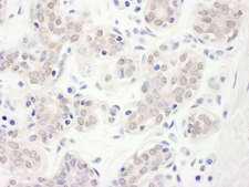 CBLL1 / HAKAI Antibody - Detection of Human Hakai by Immunohistochemistry. Sample: FFPE section of human breast carcinoma. Antibody: Affinity purified rabbit anti-Hakai used at a dilution of 1:1000 (1 ug/ml). Detection: DAB.