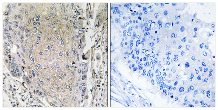 CBLN3 / Cerebellin 3 Antibody - Immunohistochemistry analysis of paraffin-embedded human lung carcinoma tissue, using CBLN3 Antibody. The picture on the right is blocked with the synthesized peptide.
