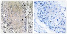 CBLN3 / Cerebellin 3 Antibody - Peptide - + Immunohistochemistry analysis of paraffin-embedded human lung carcinoma tissue using CBLN3 antibody.