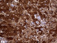 CBR / CBR1 Antibody - Immunohistochemical staining of paraffin-embedded Carcinoma of Human liver tissue using anti-CBR1 mouse monoclonal antibody. (Heat-induced epitope retrieval by 1mM EDTA in 10mM Tris buffer. (pH8.5) at 120°C for 3 min. (1:2000)