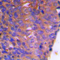 CBR / CBR1 Antibody - Immunohistochemical analysis of CBR1 staining in human breast cancer formalin fixed paraffin embedded tissue section. The section was pre-treated using heat mediated antigen retrieval with sodium citrate buffer (pH 6.0). The section was then incubated with the antibody at room temperature and detected using an HRP conjugated compact polymer system. DAB was used as the chromogen. The section was then counterstained with hematoxylin and mounted with DPX.
